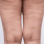 Was ist Cellulitis und wie kann man sie an den Beinen vermindern?